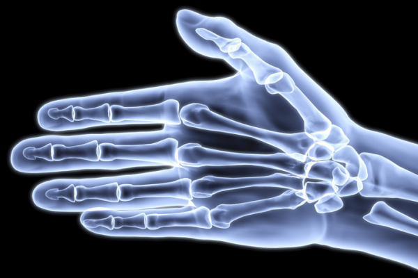 Dupuytren’s contracture of the hand